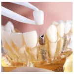 tooth implant cost in mumbai